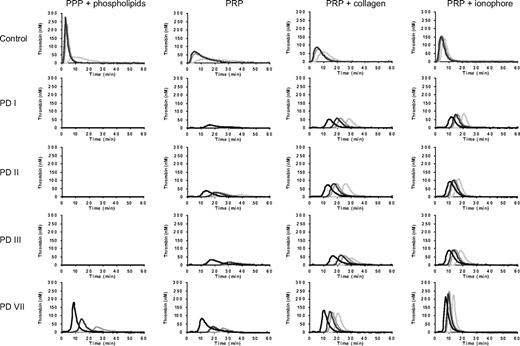 Figure 2. Thrombin generation in PPP and PRP from patients with severe congenital FV deficiency. PPP and PRP from patients PD I, PD II, PD III, and PD VII were triggered with 1 (light gray), 5 (middle gray), 10 (dark gray), or 50 (black) pM of TF, and thrombin generation was determined as described in “Thrombin generation assays.” Thrombin generation in PRP was measured without the addition of any platelet agonist and after preactivation of platelets with collagen (10 μg/mL) or Ca2+-ionophore (20μM). A representative control is shown for comparison.