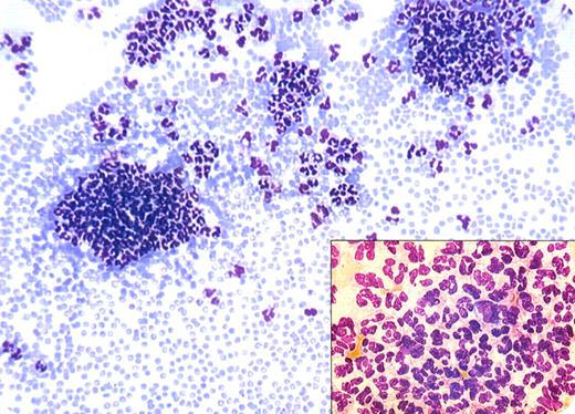 A 78-year-old man with history of heart failure was admitted for coronary angiography in the Cardiologic Unit. Complete blood count showed a mild leukopenia (3.8 × 109/L) and normal platelets and hemoglobin. The peripheral blood smear, seen above, showed agglutination of polymorphonuclear neutrophils (PMNs). The patient went home without further investigations. / Agglutination of white blood cells is a rare in vitro phenomenon with usually little clinical correlation. When PMN aggregates appear, they are usually visible at the edges of the blood smear. Careful morphologic examinations show that a few monocytes are sometimes entrapped within the aggregates. Rarely, aggregates of lymphocytes may be seen. / This laboratory abnormality is usually seen with ethylenediaminetetraacetic acid (EDTA) anticoagulants. Confirmation of a relationship of agglutination with EDTA can be accomplished by viewing a smear from capillary blood or with other anticoagulants. / Unrecognized leukoagglutination may prompt a variety of clinical concerns, diagnostic testing, and unnecessary treatment (antibiotics, growth stimulants, etc).