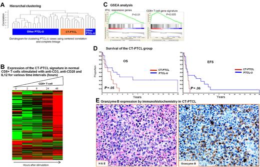 Figure 3. A unique subgroup within PTCL-NOS with features of cytotoxic T-cells (CT-PTCL). (A) Hierarchical clustering of the PTCL-NOS group demonstrated a distinct cluster of 11 cases that also clustered together when SOM and KM were used. (B) Gene signature associated with CT-PTCL was highly expressed in activated CD8+ T cells. (C) GSEA analysis identified enrichment of CD8+ T-cell and other gene signatures. The enrichment score curves were obtained from GSEA software. Vertical black lines indicate the position of the enriched genes (Hit) comprising the gene set. The graph on the bottom of each panel shows the ranked list metric (signal-to-noise ratio) for each gene as a function of the rank in the ordered dataset (see Subramanian et al27 for more details). (D) Kaplan-Meier plots of OS and EFS of CT-PTCL and the remaining PTCL-NOS cases indicating poor prognosis of CT-PTCL. (E) A representative CT-PTCL case was immunostained for Granzyme B (original magnification 200× for both panels).