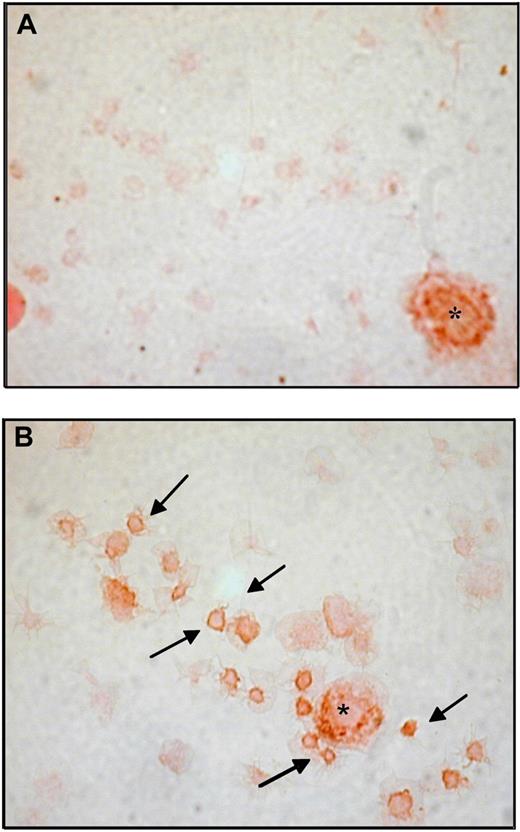 Figure 2. Representative immunohistochemistry for COX-2 in washed platelets from ET patients and healthy subjects. Immunoperoxidase of washed platelets from a control subject (A) and a patient (B), stained for COX-2 revealed with diaminobenzidine chromogen; platelets were lightly counterstained with eosin. Examples of COX-2-positive platelets are indicated by. In each panel a COX-2-positive leukocyte is visible and indicated by the asterisk as intensity staining control. Samples were analyzed by light microscopy using an Axioskop microscope (Zeiss), with an objective lens type Plan-neo Fluar (Zeiss) at a numerical aperture of 1.30, in oil. Original magnification, ×1000. Images were photographed by a CoolPix 950 digital camera (Nikon).