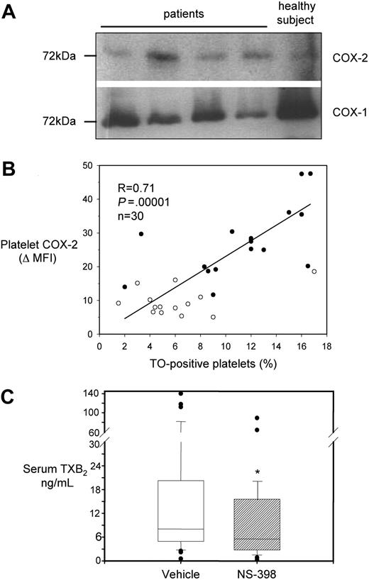 Figure 3. Characterization of COX-2 expression and activity in platelets from ET patients. (A) Western blot analysis of platelet protein extracts for COX-1 and COX-2 in 4 patients and 1 healthy subject. Proteins were extracted from washed platelets and electrophoresed in 10% SDS polyacrylamide gel under reducing conditions. Gels were blotted onto nitrocellulose membranes, which were incubated with monoclonal antibodies against COX-1 or COX-2. Positivity was revealed by anti–mouse horseradish peroxidase–conjugated antibodies and ECL detection reagent. Protein bands were visualized using Kodak Biomax light film. (B) Correlation between COX-2 expression in platelets, expressed as ΔMFI, and the percentage of TO-positive platelets in 16 patients (●) and 14 healthy subjects (○). (C) Box-whisker plots representing whole blood TXB2 production in vitro, as reflected by serum TXB2, in samples from 41 ET patients incubated with vehicle (open box) or NS-398 (striped box) added in vitro, at V0. *P < .001 versus vehicle.