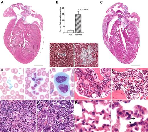 Figure 2. Histopathologic and hematologic abnormalities of A/J-trac/trac mice. (A) Heart and myocardium (inset) of A/J +/? control mouse showing normal structure, higher magnification insets of boxed areas. (B) Determination of collagen deposition in heart ventricles by color-subtractive computer-assisted image analysis showed a mean of 1.9% collagen in A/J +/? controls and 14.6% in A/J-trac/trac mice, a 7-fold increase in collagen deposition (n = 5). (C) Heart and myocardium (inset) of A/J-trac/trac mouse showing cardiomyopathy with severe multifocal fibrosis. (D-L) Peripheral blood smears and histopathology of BM, spleen, and lungs. (D-F) Blood smears of A/J-trac/trac and +/? control mice at 10 weeks of age. (D) A/J +/? mouse blood smear showing normal platelet size. (E) A/J-trac/trac blood smear showing greatly enlarged platelets. (F) A/J-trac/trac blood smear showing megakaryocyte. (G-H) Vertebral BM at 15 weeks. (G) A/J +/? BM showing normal distribution of megakaryocytes. (H) A/J-trac/trac BM showing increased numbers of megakaryocytes. (I-J) Red pulp of spleen. (I) A/J +/? spleen showing normal distribution of megakaryocytes. (J) A/J-trac/trac spleen showing increased numbers of megakaryocytes. (K-L) Lungs. (K) A/J +/? lungs showing normal structure. (L) A/J-trac/trac lungs showing megakaryocytes in alveolar capillary bed (arrows). (A,C) Masson trichrome stain; bars represent 1 mm. (D-F) Wright stain. (G-L) Hematoxylin and eosin; bars represent 10 μm.