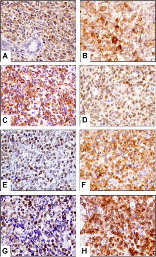 Figure 1. Validation of gene expression profiling by immunohistochemistry. Representative NKTCLs disclosed cytoplasmic staining of neoplastic cells for (A) gzm H, (B) EBI3, (C) VEGFA, nuclear localization of (D) pSTAT3, (E) pAKT, cytoplasmic and nuclear staining of (F) RelA, and positivity for (G) PDGFRα and (H) pPDGFRα. Images were captured with a Zeiss Axioskop2 microscope (Zeiss). Photographs were taken with an Olympus DP70 camera. Image acquisition was performed with Olympus DP Controller 2002, and images were processed with Adobe Photoshop Version 7.0 (Adobe Systems). Original magnification, ×400 (A-H).