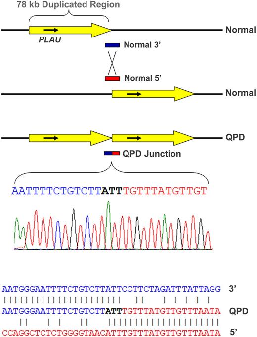 Figure 1. Tandem duplication of PLAU in subjects with QPD and alignment of the junction sequence. The duplicated, approximately 78-kb region (yellow arrow) on chromosome 10 in QPD includes PLAU and all of its characterized regulatory elements (top diagram, not to scale) and C10orf55 (not shown) on the antisense strand to PLAU, a gene of unknown function. Alignment of the breakpoint junction between the copies (below) with the normal gene sequence indicates that the QPD duplication resulted from nonhomologous recombination.