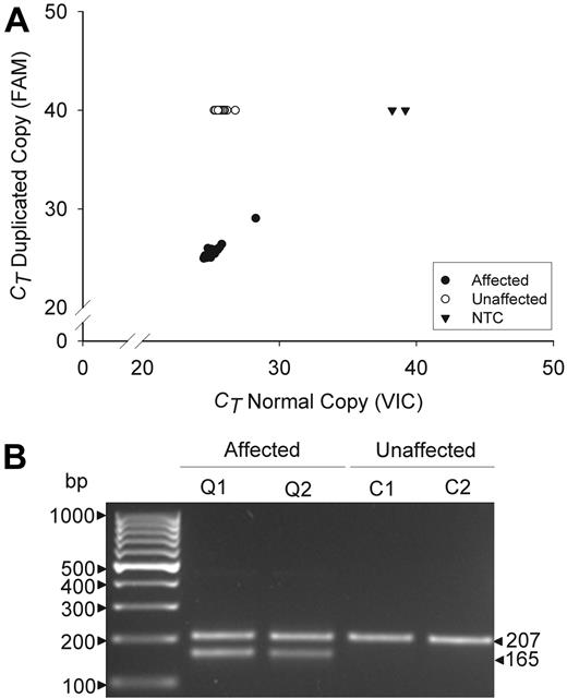Figure 2. Genotyping assays for the tandem duplication of PLAU in QPD. Panels compare data for affected (Q) and unaffected (C) QPD family members. (A) Real-time assay findings compare the cycle thresholds (CT) of the normal (VIC) and duplicated (FAM) allele copies for 38 affected and 54 unaffected family members, tested on the same run. CT values of 40 indicate an undetectable genotype. NTC indicates no template controls. (B) Multiplex fragment size assays show the 207-bp and 165-bp fragments that correspond to the normal and duplicated copies of PLAU (representative subjects shown).