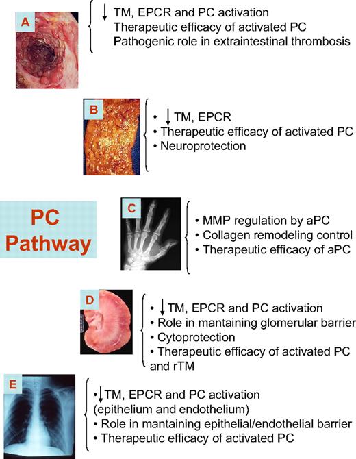 Figure 2. The PC system in inflammatory disease. The PC pathway plays an important role in several human inflammatory conditions. Members of the PC pathway are down-regulated in patients with these diseases, and therapeutic efficacy has been observed for biologic therapeutics that modulate the PC pathway. (A) IBD. (B) Atherosclerosis. (C) RA. (D) Glomerulonephritis. (E) Asthma.