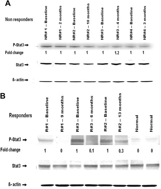 Figure 2. Western blot analysis of STAT3 and P-STAT3 in mononuclear cells obtained from patients before and during therapy. (A) Nonresponders. (B) Responders. Time point at which samples were obtained is indicated. NR indicates nonresponder; and R, responder.