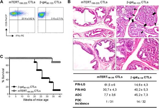 Figure 3. Therapeutic impact of mTERT-based ACT on TRAMP mice. (A) Activated CTLs are able to traffic to prostate tumor. TRAMP mice were subjected to 3 consecutive ACTs and, 4 days after last ACT, prostate tumors were harvested and stained to track either mTERT-specific (CD8+/Vβ11+) or β-gal–specific(CD8+/Vβ8.1+) CTLs. IFN-γ and CD8 staining is shown on cells gated for specific Vβ expression. Data are mean ± SD of 3 mice. (B) Representative histologic pictures of prostates of TRAMP mice treated with either mTERT198-205–specific (left) or control CTLs (right) at 24 weeks of age. Prostate in majority of mTERT-specific CTL treated mice is occupied by PIN-LG foci, showing normal sized glands lined by few and flat layers of atypical cells. In control mice, PIN-HG–affected prostatic ductules appear enlarged and distorted by crowded intraluminal papillae coalescing into cribriform structures (arrowheads). Numerous solid nests of adenocarcinoma (arrows) focally invade base membrane (see also insert; magnification: top panels, ×200; bottom panels, ×400). The table summarizes the prostate areas occupied by different tumor lesions. Values are expressed as mean ± SE. The incidence of PDC also is indicated. Wilcoxon rank sum test: PIN-LG is more represented in TERT-specific CTL-treated animals (P = .001); PIN-HG is not statistically different; adenocarcinoma (ADC) is more represented in β-gal–specific CTL-treated mice (P = .001). The incidence of PDC was evaluated with the Fisher exact test (P = .001). (C) Overall survival of TRAMP mice undergoing ACT. Survival curves from TRAMP mice treated with either mTERT-specific (n = 9) or β-gal–specific (n = 10) CTLs are shown. Kaplan-Meier analysis: mTERT vs β-gal, P < .001.