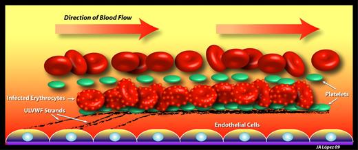 Mechanisms of infected erythrocyte adhesion to endothelium in cerebral malaria. Early in the blood stage of P falciparum infection, endothelial cells become activated to secrete ULVWF strands, which remain attached to the endothelial surface and rapidly bind platelets. Infected erythrocytes, coated with membrane knobs rich in PfEMP1, adhere to the platelet-decorated ULVWF strings through platelet CD36. ULVWF contributes to both the thrombocytopenia and hemolytic anemia of malaria by binding large numbers of platelets and by shearing red cells.