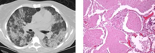 Figure 2. PAP in patient 3.I.1. Computed tomography (left) demonstrates significant bilateral airspace disease. Histopathology (right) demonstrates excessive accumulation of amorphous proteinaceous material in the alveolar spaces. Images were taken using an Olympus Bx41 microscope, objectives UPlanFI 40×/0.75 ∞/0.17, and UPlanFI 20×/05.0 ∞/0.17, with an adaptor U-TV0.5×C using a digital camera Q-imaging Micropublisher 5.0RTV. The images were captured using Q-Capture Version 3.1 and imported into Adobe Photoshop 7.0.
