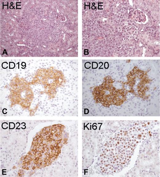 Figure 3. Histopathologic analysis of organ localizations. Histopathologic analysis of the kidney from Rag2−/−γc−/− male mice injected subcutaneously with MEC1 cells showed discrete collections of tumoral lymphocytes (A and B: H&E staining, magnification ×200 and ×400, respectively). These neoplastic nodules displayed homogeneous distinctive immunoreactivity for human CD19 (C), CD20 (D), and CD23 (E), with a substantial proliferation index (F: Ki67).