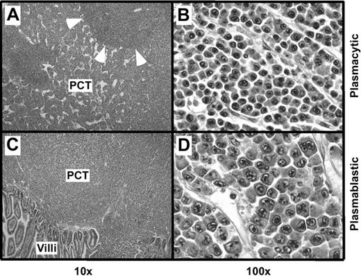 Figure 2. Histopathology of PCT. (A) Mesenteric lymph node containing a plasmacytic PCT. Residual follicles, such as the one indicated by arrowheads, are displaced by large interfollicular expansions of mature plasma cells. (B) High-power view of the interfollicular area containing aberrant, yet relatively small, plasma cells with varying amounts of cytoplasm. (C) Small bowel mucosa harboring a plasmablastic PCT with sheets of abnormal plasma cells infiltrating the mucosa. (D) High-power view showing atypical, large plasma cells with pleomorphic nuclei, prominent nucleoli, and varying amounts of cytoplasm, consistent with the diagnosis of plasmablastic PCT. Original magnification: ×4 (A,C) and ×40 (B,D). Final magnification: ×10 (A,C) and ×100 (B,D).