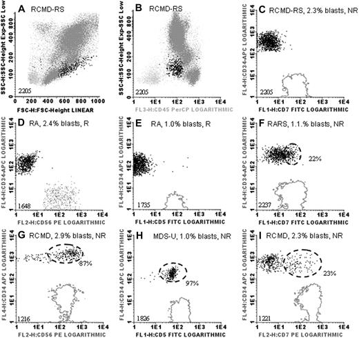 Figure 1. Examples of immunophenotypic analysis of myeloid blasts in low- and intermediate-I–risk MDS. (A) Forward light scatter (FSC) and sideward light scatter (SSC) properties of a bone marrow sample of a myelodysplastic syndrome (MDS) patient are depicted (unique patient numbers are depicted in lower left corners). FSC (x-axis) and SSC (y-axis) reflect size and granularity, respectively. (B) CD45 staining (x-axis) versus SSC (y-axis) in this patient; CD45 is expressed on all white blood cells (highlighted in dark gray and black). CD34+ myeloid blasts, characterized by their diminished level of CD45 and low-to-intermediate SSC, are highlighted in black in all panels. (C-I) CD34 is depicted on the y-axes and lymphoid markers on the x-axes. Fluorescence 1 (FL1), FL2, FL3, and FL4 indicate fluorescein isothiocyanate–, phycoerythrin-, peridinin-chlorophyll protein–, and APC-conjugated antibodies, respectively. Solid gray lines indicate expression levels of lymphoid markers CD5, CD7, and CD56 in the reference lymphocyte population (x-axes in panels C-I). (D) The natural killer cell population was too small to generate a contour line; therefore, the reference population is depicted as gray dots. Marker expression was compared with unstained cells or appropriate isotype controls. Dashed black lines are depicted in case more than 20% of myeloid blasts expressed a lymphoid marker (aberrant flow cytometry); percentages of aberrant blasts are indicated as percentage of CD34+ cells. R indicates Epo responder; and NR, nonresponder. Graphs were generated with the use of Infinicyt software (Cytognos).