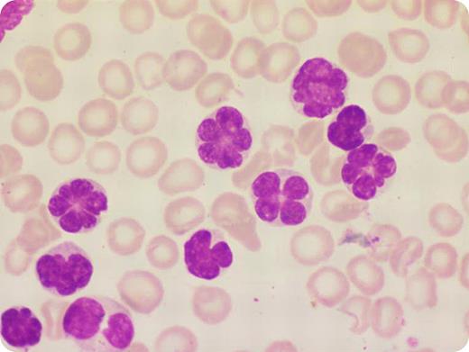 A 22-year-old female presented with 2 weeks of fever, anemia, generalized lymphadenopathy, hepatosplenomegaly, and skin rashes. Her total leukocyte count was 306 × 109/L. Peripheral blood smear showed many atypical lymphocytes with petal-shaped nuclei like flowers as seen in the photograph. Peripheral blood immunophenotype noted negative markers for myeloid and B lymphoid lineage (CD10, CD19, CD3, CD5, CD7, cyto-CD3, TCR, CD16, CD56) and strongly positive for CD4 and CD25, and also CD2, which was atypical. Bone marrow aspirate and biopsy revealed involvement by acute leukemia. Serology for HTLV-1 was positive and serum calcium was normal. / A diagnosis of adult T-cell leukemia was made. This leukemia is a neoplastic disease of CD4-positive T lymphocytes. Flower cells are described typically in HTLV-1–induced adult T-cell leukemia. They may also be seen in asymptomatic carriers of HTLV-1. Although convoluted nuclei with high total leukocyte count can occur in Sézary syndrome, a typical petal shape of nuclei is usually not seen. In this patient, the clinical presentation and peripheral blood smear strongly indicated adult T-cell leukemia; HTLV-1 and the immunophenotype provided additional evidence. The patient received intensive chemotherapy but died of neutropenic fungal infection.