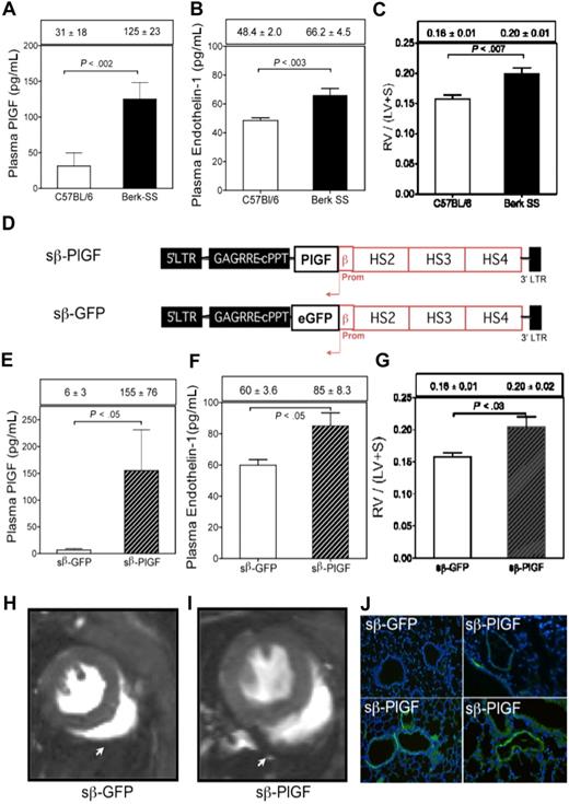 Figure 1. Overexpression of PlGF contributes to development of PH. (A-C) Plasma PlGF, endothelin-1 levels, and RV mass in Berk-SS mice compared with normal controls. RV mass is expressed as a ratio of RV wall weight/left ventricle wall (LV) + septum (S) wet weights; n = 4 to 8 animals/group. (D) Lentivirus vector constructs designed to express PlGF or GFP cDNA under the control of β-globin gene promoter and hypersensitive (HS) sites 2, 3, and 4 of the β-globin locus control region. (E-G) Plasma PlGF and endothelin-1 levels in normal C57Bl/6 mice that express either PlGF or GFP from erythroid cells and RV mass, in these mice; n = 4 to 8 animals/group. (H-I) Cardiac MRI on sβ-GFP and sβ-PLGF-expressing mice at 16 weeks; n = 4. A representative view of the RV at the same plane in sβ-GFP and sβ-PLGF mice is shown; RV wall (arrow) hypertrophy and higher RV end-diastolic volume (not shown) were seen qualitatively. (J) Immunostaining of lungs for smooth muscle actin of 1 representative sβ-GFP mouse and 3 sβ-PlGF mice (shown as green fluorescence). All bar graphs represent mean and SEM; comparisons were made using t tests. Fluorescence images were obtained using a Leica DMI 6000 Fluorescence microscope with a 20× objective. Image acquisition was done using OpenLab Version 5.5 (Improvision).