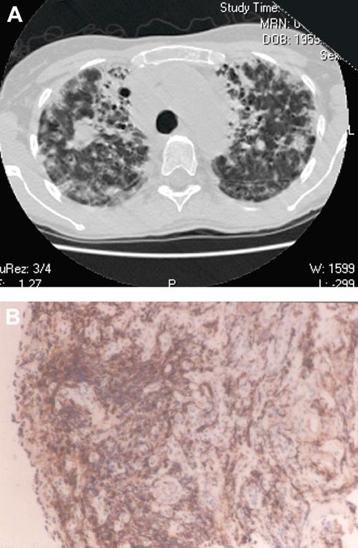 Figure 1. Lymphocytic pulmonary infiltrates. (A) A 40-year-old woman with gradually worsening severe lung disease. Computed tomography of the chest revealed massive infiltrates composed of lymphocytic collections and fibrotic scars. (B) On biopsy, the infiltrating T cells in the lung, obliterating normal architecture, were revealed as CD4+ by the brownish monoclonal peroxidase conjugated monoclonal anti-CD4− staining pattern (magnification ×25).