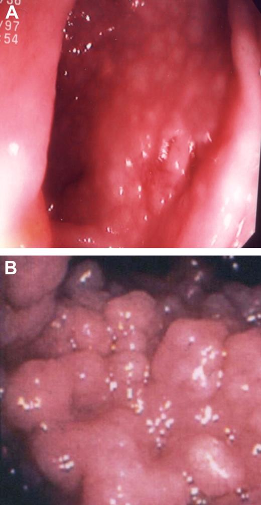 Figure 2. Gastrointestinal lymphoid nodules. (A) A 50-year-old woman who had a history of a duodenal ulcer, now resolved. She had a repeat gastroscopy for symptoms of gastritis; H pylori was not found. The mucosa of the stomach folds of this female patient contained numerous lymphoid follicles. (B) The jejunum of a 28-year-old male patient containing massive nodules of lymphoid hyperplasia; he had experienced a 20-lb weight loss.