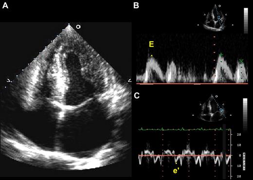 Representative echocardiographic images from a patient with sickle cell disease. (A) Apical 4-chamber view showing concentric left ventricular hypertrophy and a dilated left atrium. (B) Doppler of the mitral inflow used to obtain a peak E velocity for early ventricular filling. (C) Tissue Doppler of the lateral mitral annulus used to obtain a peak e′ velocity. The E/e′ ratio is an indicator of left ventricular filling pressures and is used in the assessment of diastolic dysfunction.