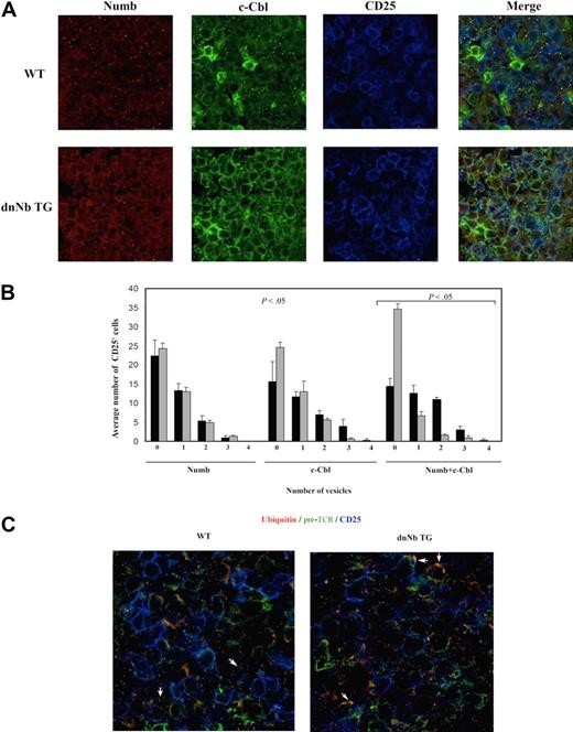 Figure 6. Less endosomal Numb and more ubiquitylated membrane pre-TCR in fetal dnNb TG thymocytes. (A) Confocal images of fetal thymic frozen sections stained with antibodies against Numb (red), c-Cbl (green), and CD25 (blue). (B) Average number of CD25+ cells containing from zero to 4 c-Cbl+, Numb+, and c-Cbl+Numb+ vesicles. Four independent images for each line (WT and dnNb TG) were processed. For colocalization, analysis masks for c-Cbl (green) and for Numb (red) were made with Photoshop 7.0. Numbers of vesicles per CD25+ cell in each mask were counted. The same analysis was performed in masks containing Numb and c-Cbl together (yellow). An average of 34 and 45 CD25+ cells per image were counted for WT (black bars) and dnNb TG (gray bars), respectively. (C) Confocal images of fetal thymic frozen sections of WT (left) and dnNb TG (right) mice, stained with antibodies against ubiquitin (red), pre-TCR (green), and CD25 (blue). White arrows point to cells with intracellular ubiquitin+/pre-TCR+ vesicles (left) or membrane ubiquitin+/pre-TCR+ accumulations (right). All data are representative of at least 3 independent experiments.