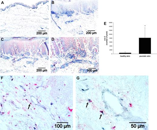 Figure 6. Cox-2 expression is enhanced in lesional psoriatic skin. Cox-2 expression (red) was detected by immunohistochemistry in (A) healthy skin and (C-D) in psoriatic skin. Nuclei were stained by hematoxylin (blue). (B) An isotype control antibody in lesional psoriatic skin served as negative control. (E) For quantification of Cox-2 expression, morphometric image analysis was performed by scanning 5 images per sections. The sum of pixels was evaluated, and the mean plus or minus SD of the number of pixels from 6 different psoriatic skin samples and 6 healthy skin samples is shown. (F-G) In lesional psoriatic skin, fibroblasts were detected by an anti–Thy-1 antibody (blue-gray) and Cox-2 expression by the anti–Cox-2 antibody (red). Arrows indicate Thy-1/Cox-2 double-positive cells.
