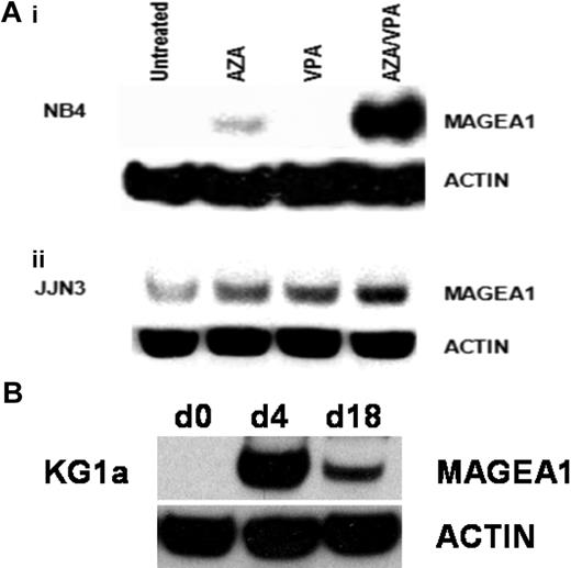 Figure 2. Induction of MAGE-A1 protein expression in myeloma and AML cell lines by AZA and VPA. (A) NB4 (i) and JJN3 (ii) cell lines were treated as indicated, and the induction of MAGE-A1 protein expression was examined by Western blotting with the anti–MAGE-A antibody (clone MA454; Sigma-Aldrich). Blots were stripped and reprobed for β-actin (mouse monoclonal anti–β-actin, ac-74; Sigma-Aldrich) as a loading control. (B) Time-course studies showing durability of azacitidine/sodium valproate (AZA/VPA)–induced expression changes. KG1a cells were treated with AZA/VPA as before (d4) and then passaged 1:10 in fresh media once per week for 2 weeks before protein was harvested for MAGE-A1 expression analysis. AZA indicates azacitidine; d0, baseline; d4, day 4; and d18, day 18.