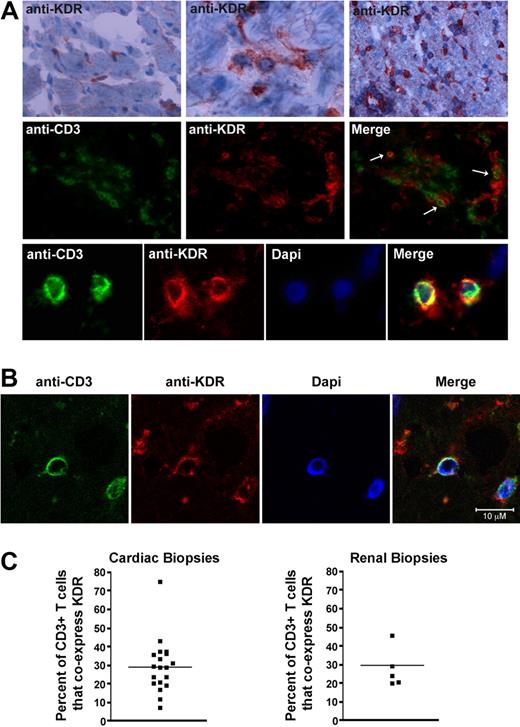 Figure 2. Expression of KDR on T cells within human cardiac and renal allografts. (A) Representative photomicrographs illustrating the expression of KDR within human cardiac allografts. Top panels: immunohistochemical staining of KDR (rose brown color) in 3 human cardiac allografts with few (left top panel), moderate (middle top panel), and diffuse (right top panel) infiltrates. Middle and bottom panels: Immunofluorescence staining of CD3 and KDR in a representative cardiac allograft at ×400 magnification (middle) and 800× magnification (bottom). Merged images illustrate coexpression of CD3 and KDR (yellow color, arrows). (B) Confocal microscopy of a representative cardiac allograft with evidence of rejection illustrating coexpression of CD3 with KDR. (C) Scatter graphs showing the percentage of CD3+ stained T cells that coexpress KDR in cardiac and renal biopsies (black dots represent individual biopsies). The line shows the mean percent expression in all biopsies examined.