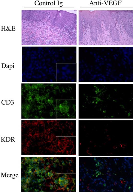 Figure 7. The effect of anti-VEGF on the recruitment of KDR-expressing lymphocytes in vivo. SCID mice with human skin transplants were humanized by adoptive transfer of human PBMCs intraperitoneally. At the time of humanization, and every other day, the mice received human IgG or humanized anti–human VEGF (5mg/kg in 100μl saline). After 14 days, the skin grafts were harvested and were analyzed by H&E staining and by immunofluorescence. Illustrated in the lefthand panels are representative photomicrografts of skin grafts harvested from mice treated with control IgG. The photomicrografts illustrated in the right panels are representative of skins harvested from mice treated with anti-VEGF. Expression of CD3 is illustrated in green, KDR in red, and the merged images (bottom panels, yellow color) illustrate coexpression of KDR with CD3 on T-cell infiltrates. Magnification of all micrographs, ×400. Boxed insets, magnification × 800. Representative of n = 4 mice in each group.