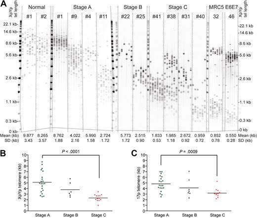 Figure 1. Poor-prognosis CLL patients exhibit short telomere length distributions. (A) XpYp STELA gels displaying the telomere length profiles in B cells from normal and CLL patients and MRC5 fibroblast cells entering crisis in culture after the expression of HPV E6E7.6 Binet staging is indicated above the CLL samples. PD is detailed above the MRC5 samples; mean and SD are detailed below. The mean for the MRC5 cells is for the shorter of the 2 XpYp telomeric alleles. At PD53, the short telomere has disappeared. (B-C) Scatter plots of mean length at the XpYp and 17p telomeres plotted against Binet.