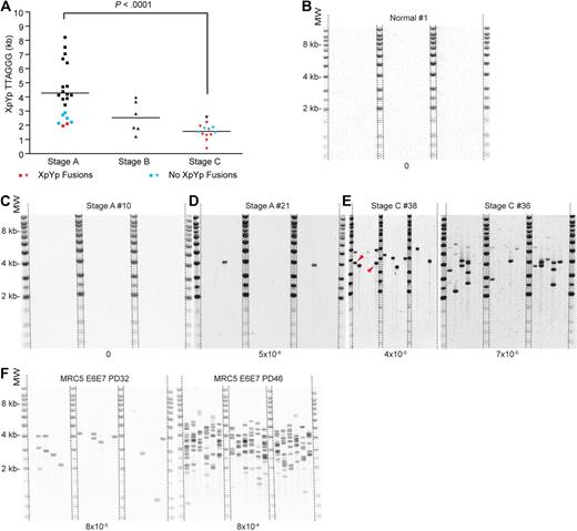 Figure 3. CLL patients displaying short TTAGGG repeat lengths exhibit telomere fusion. (A) Scatter plot displaying XpYp telomere length in terms of TTAGGG repeats distal to the TVR region. Persons marked in color were analyzed for fusion: red represents fusion was detected; and blue, fusion was not detected. (B-C) Telomere fusion assay in one normal person and one stage A patient, both of whom show no evidence of telomere fusion. (D-E) Examples of telomere fusion in stage A and stage C patients. Each band represents a single fusion event. Fusion was detected by Southern hybridization with the XpYp telomere-adjacent DNA probe. Red arrows indicate an example of a clonal fusion event, verified by sequence analysis (Figure 3C). (F) Fusion assay applied to MRC5 fibroblast cells expressing HPVE6E7 entering crisis in culture6; PD points are indicated above. Frequencies of fusion of the XpYp telomere with a subset of 13 chromosome ends are indicated below each blot. These frequencies are useful as a comparator of relative fusion frequencies but represent considerable underestimate of the genome-wide frequency of telomere fusion.
