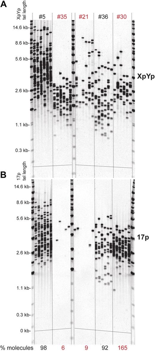 Figure 5. Complete telomere loss in CLL patients. (A) XpYp and (B) 17p STELA LOH is detected when there is a differential number of amplifiable molecules between the 2 telomeres; the percentage of telomeric molecules at 17p relative to that detected at the XpYp telomere is shown below the 17p STELA blot. Two persons show almost complete LOH at 17p (#35 and #21) and one (#30) shows loss of one XpYp allele, highlighted in red.