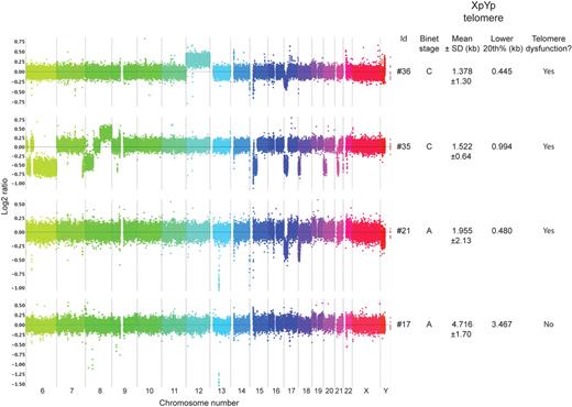 Figure 6. Genomic instability in CLL patients exhibiting telomere dysfunction. Array-CGH (NimbleGen 720k whole genome array) from chromosomes 6-Y in 3 persons that display telomeric dysfunction in the form of telomeric LOH (#21 and #35) and fusion (#21 and #36). One person showed no evidence of telomere dysfunction. Binet stage, XpYp (mean ± SD), and lower 20th percentile are shown to the right of each rainbow CGH view.