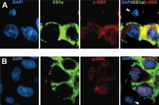 Figure 1. Immunofluorescence analysis of BRAF pathway activation in LCH. (A) LCH sample stained with DAPI (blue), anti-CD1a (green), antiphospho-MEK (red), and a merged image of all 3 stains. (B) LCH sample stained with DAPI (blue), anti-CD1a (green), antiphospho-ERK (red), and a merged image of all 3 stains. Arrowheads indicate CD1a-negative cells that are also negative for phospho-MEK and phospho-ERK. (Technical details described in supplemental Methods.)