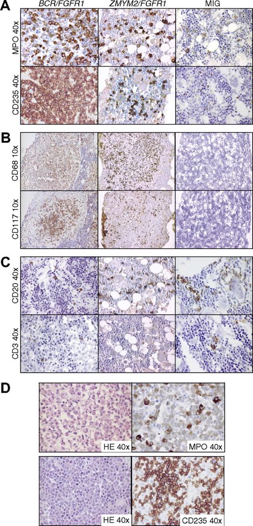 Figure 4. Immunostained BM sections from BCR/FGFR1, ZMYM2/FGFR1, and MIG NOD/SCID mice. (A) BCR/FGFR1 and ZMYM2/FGFR1 mice display increased levels of human granulocytic and erythroid cells in BM as shown by immunostaining for MPO and CD235a. BM sections from a representative MIG mouse reveal single granulocytic and erythroid human cells staining positive for MPO and CD235a. (B) Human cells in BCR/FGFR1 and ZMYM2/FGFR1 mice BM also differentiated into macrophages and mast cells as shown by morphology and positive staining for CD68 and CD117 in BM sections from representative mice. Typically, macrophages and mast cells formed round clusters of cells. In MIG mice, only few cells stained positive for CD68 or CD117. (C) In BM sections from BCR/FGFR1 and ZMYM2/FGFR1 mice, as well as from MIG mice, dispersed B-lymphoid cells, staining positive for CD20 were found, whereas T-lymphoid cells positive for CD3 were more rarely detected. (D) In BCR/FGFR1 mice, human granulocytopoiesis frequently displayed a left-shifted maturation pattern with eosinophilia, as shown by morphology in HE stained sections and immunostaining for MPO (top panel). Furthermore, accumulation of erythroid blasts as shown in HE stained sections and by CD235a staining was observed (bottom panel).