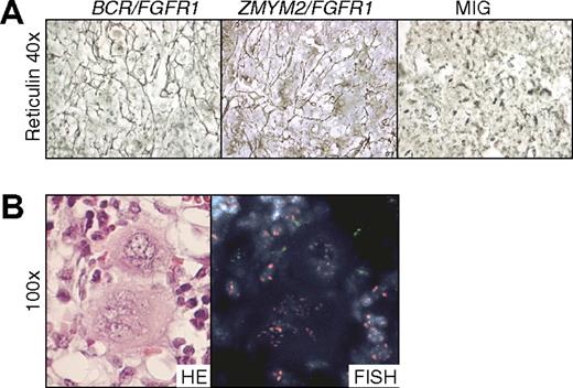 Figure 5. NOD/SCID mice transplanted with BCR/FGFR1- and ZMYM2/FGFR1-expressing cells display BM fibrosis. (A) Reticulin-stained BM sections from a representative BCR/FGFR1 mouse and a ZMYM2/FGFR1 mouse reveal pronounced fibrosis, whereas all MIG mice displayed normal reticulin. (B) Two representative megakaryocytes from BCR/FGFR1 mouse BM shown to be of murine origin as determined by FISH analysis (red signals, murine cells; green signals, human cells).