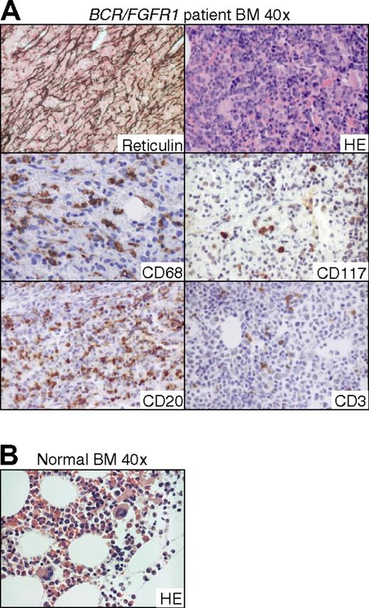 Figure 7. BM sections from the patient in which the BCR/FGFR1 fusion gene originally was isolated show similarities with BCR/FGFR1-induced effects in the NOD/SCID and NSG mouse models. (A) Reticulin-stained section demonstrates a pronounced BM fibrosis and HE staining shows infiltration of blasts (top panel). Numerous macrophages staining positive for CD68 and occasionally mast cells, as defined by morphology and CD117 staining, are also found (middle panel). CD20+ B cells are more frequent than CD3+ T cells (bottom panel). Due to admixture of peripheral erythrocytes, a CD235 stained section could not be conclusively analyzed. (B) HE-stained section from a normal healthy BM.