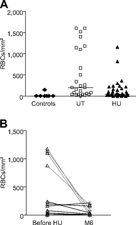 Figure 1. Fewer SS RBCs adhered to laminin during HU treatment. (A) Blood samples from 7 healthy controls, 28 untreated (UT), and 34 HU-treated patients (HU). Horizontal lines represent medians. UT RBCs were more adherent than HU RBCs (2 dyn/cm2, P = .007; Mann-Whitney test). Exposure to HU led to less dispersion of HU group values compared with the UT group (P < .001; Fisher exact test). (B) For the pre-post group, RBC adhesion was significantly lower after 6 months of HU (M6) than before (2 dyn/cm2, n = 13; P = .013; Wilcoxon signed-rank test).