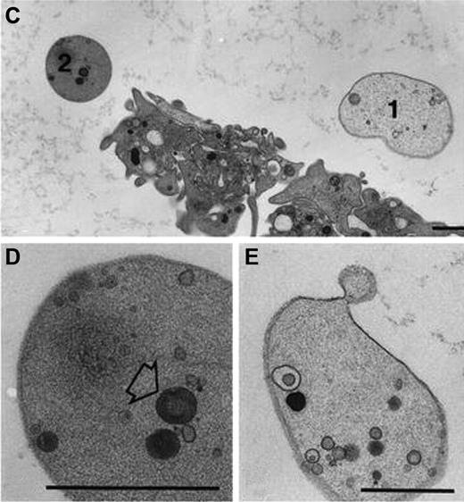 Figure 4. Procoagulant balloon-shaped platelets. Ultrastructure of procoagulant platelets adhering to collagen-related peptide in the presence of calcium (2mM). Balloon platelets appear completely smooth, apart from an occasional membrane bleb. (Top panel) Comparison between normal platelets and balloon platelets (types 1 and 2). The cytoplasm of balloon platelets contain only few (if any) randomly distributed organelles, or remnants thereof. 2 such examples are presented in the bottom panels. (Left panel, type 1): Highly diluted cytoplasm and few inclusions. (Right panel, type 2): Moderately dense cytoplasm and higher levels of organelles. These images have been reproduced from Hess and Siljander33 Figure 1C through E with permission from Springer Science+Business Media.