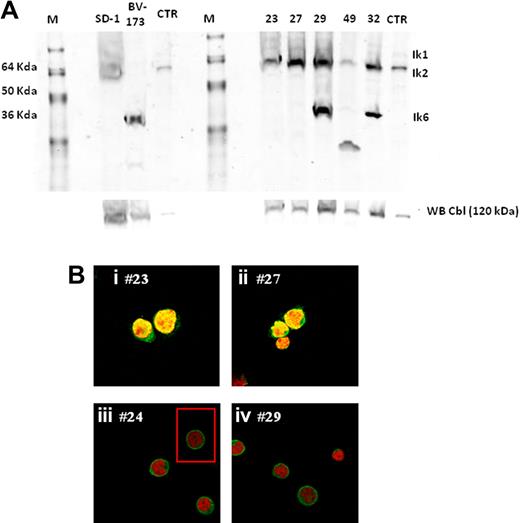 Figure 2. Ikaros protein expression and compartmentalization. (A) Anti-Ikaros Western blots of whole cell lysates from leukemic cell lines (SD-1 and BV-173), leukemic bone marrow mononuclear cells from Ph+ ALL at diagnosis (ID 23, ID 27, ID 29, ID49, and ID 32), and a control Jurkat cell nuclear extract. The positions corresponding to the migration patterns of Ik-1 (∼ 57 kDa), Ik-2 (∼ 47 kDa), and Ik-6 (∼ 37 kDa) proteins are indicated. Anti-Cbl Western blots of the whole cell lysates were performed as loading controls. (B) Expression and subcellular localization of Ikaros proteins in leukemic cells from Ph+ ALL patients. In all images, cells were stained with an anti-Ikaros antibody (green) and with propidium iodide (red) to visualize the DNA. (Bi-ii) Confocal images of leukemic cells from patients expressing full-length Ikaros isoforms show the characteristic multifocal nuclear localization pattern of Ikaros. (Biii-iv) Confocal images of leukemic cells expressing the Ik6 isoform and showing cytoplasmic expression of Ikaros (eg, bright green fluorescent rim surrounding the completely labeled red nuclei). In panel C, the cell within the red box was pasted in from another field on the same slide, and the same patient sample.