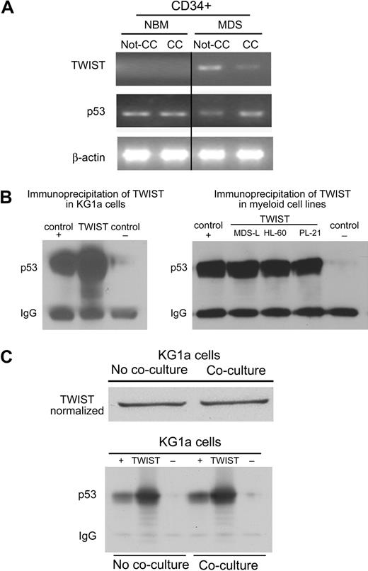 Figure 2. TWIST expression and interactions with p53 in primary CD34+ marrow cells and myeloid cell lines. (A) Primary CD34+ marrow cells from healthy donors and patients with MDS. Healthy CD34+cells (control) cultured without stroma (Not-CC) or with stroma contact (CC) showed no change in the expression of p53 or TWIST. In cells from patients with MDS, p53 showed prominent up-regulation on stroma contact (CC), whereas levels of TWIST declined. (B) Immunoprecipitation (IP) of TWIST from KG1a, MDS-L, HL-60, and PL-21 cell lysates. p53 was contained in the complex precipitated from all myeloid cell lines by anti-TWIST antibody; DJ-1 served as positive (+) and Stro-1 as negative (−) control. (C) IP as in panel B, but using KG1a cells without and with coculture, normalizing for TWIST content in the cell lysate. IgG indicates immunoglobulin G.