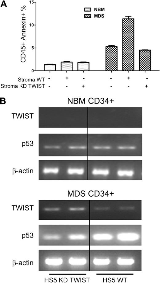 Figure 4. TWIST and p53 expression and apoptosis in primary CD34+ cells. (A) Apoptosis in CD34+ marrow cells from healthy normal bone marrow donors (NBM) and patients with MDS cocultured with either unmodified HS5 stroma or HS5 with suppression of TWIST by siRNA (KD TWIST). Apoptosis was determined by flow cytometry. Error bars indicate SEM. (B) Levels of TWIST and p53 mRNA in CD34+ cells from healthy donors (NBM) and patients with MDS cocultured with either unmodified HS5 stroma (WT) or HS5 stroma with inhibition of TWIST (KD TWIST).