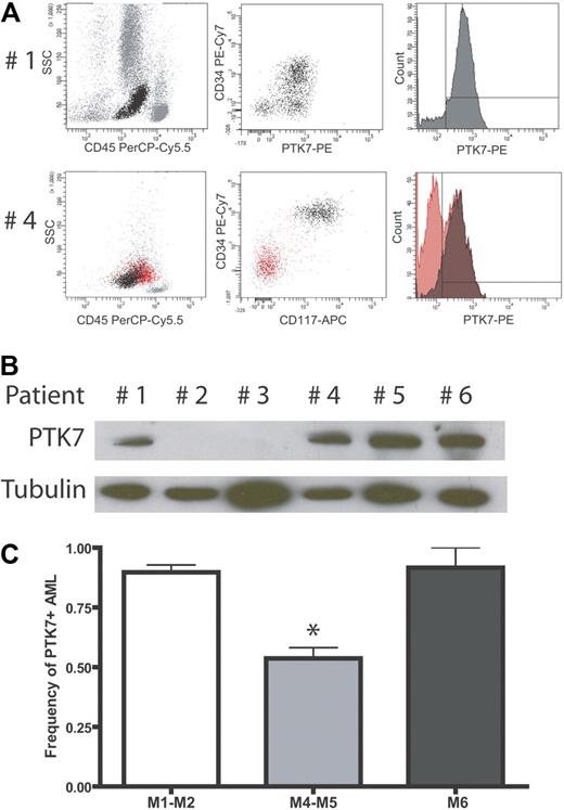 Figure 2. AML: PTK7 is expressed in a subgroup of AMLs. (A) Flow cytometric data using the monoclonal anti-PTK7 antibody. (Top panel) An AML patient with 95% of PTK7+ cells. (Bottom panel) An AML patient with a mixed blast population. In this sample, myeloid cells (CD34+ CD117+) are PTK7+, whereas monocytic blasts are PTK7−. Of note, these monocytic blasts expressed significant levels of CD11b and CD14 (data not shown). (B) Western blot of fresh AML protein extracts using a polyclonal antibody directed against PTK7. (C) Correlation of PTK7 expression with cytologic findings using the FAB classification: FAB M1, M2, and M6 AMLs frequently express PTK7 compared with FAB M4 or M5 AMLs (Fisher exact test, P < .001).