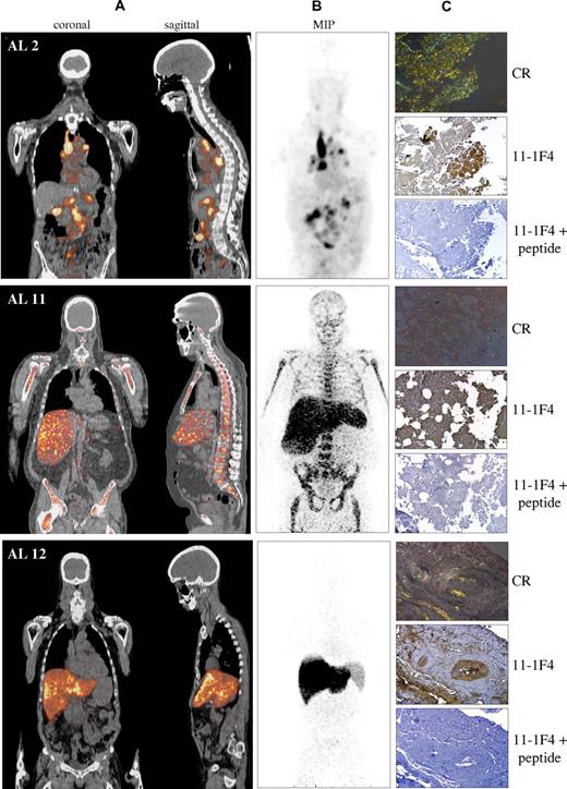 Figure 1. Radioimmunoimaging and immunohistochemical detection of AL amyloid. Three patients with systemic AL amyloidosis (AL 2, AL 11, AL 12) received an intravenous infusion of approximately 2 mCi (1 mg) of 124I-labeled m11-1F4. (A) Fused coronal and sagittal PET/CT images acquired 5-days after infusion using the high-resolution Siemens Biograph 16 (patient AL 2) or molecular CT (patients AL 11, AL 12) instruments. (B) Maximum intensity projection PET images. (C) Polarizing and light microscopy. Consecutive tissue sections from each patient (AL 2, lymph node; AL 11, bone marrow, and AL 12, liver) were subjected to histochemical (HC) staining with Congo red (CR, top) or immunohistochemical (IHC) studies using, as primary reagent, mAb 11-1F4 (middle), or, as a negative control, the antibody preincubated with a 22-mer peptide containing the conformational fibril-related epitope recognized by mAb 11-1F4 (bottom). Photomicrographs were acquired with a Leica DM 500 light microscope equipped with cross-polarizing filters. Digital images were obtained using a cooled charged coupled device camera and dedicated SPOT software (Version 3.5.2) at an original magnification × 160.