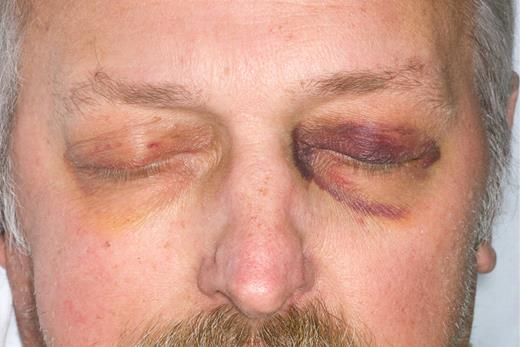 Typical amyloid palpebral purpura.