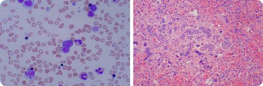 A 64-year-old female with a 10-year history of chronic idiopathic myelofibrosis (CIMF) developed massive splenomegaly. The severe mass effect caused abdominal pain, inferior vena cava compression, lower-extremity edema, and shortness of breath. Refractory to multiple medical treatments including a JAK2 inhibitor, she was to undergo a palliative splenectomy for quality-of-life improvement. At admission she was anemic (hemoglobin 7.3 g/dL), thrombocytopenic (102 × 103/μL), and with leukocytosis (70.0 × 103/μL). As seen in the image (left), numerous circulating nucleated red blood cells, poikilocytosis, anisocytosis, immature granulocytes, and giant platelets were present in her peripheral blood smear. / Surgical pathology received a 32 × 21 × 11 cm3 spleen weighing 3.8 kg. Characteristic of CIMF, significant extramedullary hematopoiesis with dysplastic megakaryocytes was seen as illustrated (right). A liver biopsy obtained at this time also demonstrated extramedullary hematopoiesis. Her postoperative clinical course was complicated with a surgical site infection, but she recovered and was discharged on postoperative day 13. At discharge, although her anemia improved (hemoglobin 8.9 g/dL), her thrombocytopenia (91 × 103/μL) and leukocytosis (67.4 × 103/μL) remained relatively unchanged, and numerous nucleated red blood cells were still present in her peripheral blood smear. Two months later, she improved clinically but similar blood abnormalities persisted. This most likely reflects active hepatic extramedullary hematopoiesis compensating for her fibrotic bone marrow.