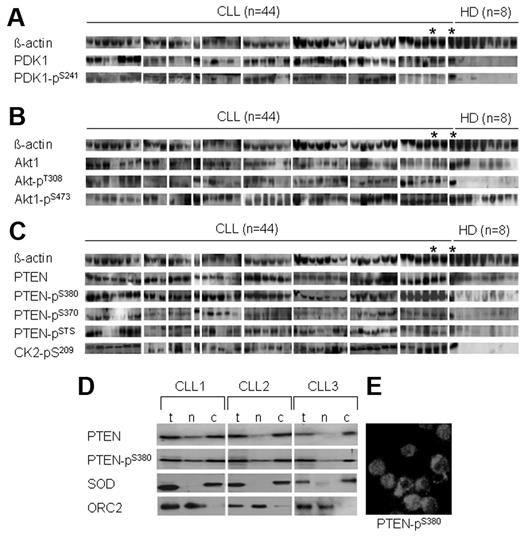 Figure 5. Activation of the PI3-K/Akt cascade and inactivation of PTEN in freshly isolated CLL cells. Basal levels of main components of PI3-K/Akt cascade in freshly isolated PBMCs of patients with CLL (n = 44) and healthy donors (HDs) were evaluated by Western blotting (the corresponding densitometric scanning is shown in Table 1). A CLL sample (*) was included in Western blotting 2 times together with the HD sets as an internal control. As shown (A), the total amount of PDK1 protein and its phosphorylated form is significantly higher in CLL samples compared with HDs (P < .001 for PKD1 and PDK1-pSer241). As shown (B), the total amounts of Akt and Akt pSer-473 varied between patients with CLL but were higher than in HD samples (P < .05 for Akt pSer-473). The amounts of Akt pThr-308 were significantly higher in most of the CLL samples compared with HD samples (P < .01). As shown (C), comparable amounts of total PTEN were detected in CLL and HD samples. Higher amounts of phosphorylated PTEN at Ser-380, pSer-370, pSTS (pSer-380/pThr-382/pSer-385; P < .01 for all) and CK2 pSer-209 (P < .001) were detected in CLL samples. As demonstrated in panel D, the expression of total PTEN (t) and PTEN pSer-380 in the cytoplasmic (c) and nuclear (n) compartments of purified CLL cells from 3 patients. SOD and ORC2 represent markers for cytoplasmic and nuclear subfraction and show the purity of cellular fractions. Cytoplasmic and nuclear distribution of PTEN-p380 is visualized by immunofluorescence staining in purified CLL cells (E).