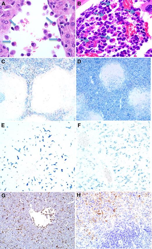Figure 1. Induction of histiocytosis and erythrophagocytosis by IL-4. (A) Hematoxylin and eosin stain (×100) of tissue from day 3 of IL-4 pump (1 μg/hour), showing activated luminal macrophages and erythrophagocytosis (arrows) within the liver. (B) Hematoxylin and eosin stain (×100) of erythrophagocytosis within the bone marrow. Immunohistochemistry (×40) for F4/80 showing increased cellular density within red pulp of IL-4 mini-pump–treated spleen (D) compared with control (C). Immunohistochemistry (×100) for F4/80 showing more diffuse and larger F4/80+ Kupffer cells within the liver of IL-4 mini-pump–treated mice (F) compared with controls (E). Ym1 immunohistochemistry in (G) liver and (H) spleen (×100) of IL-4 mini-pump–treated mouse.