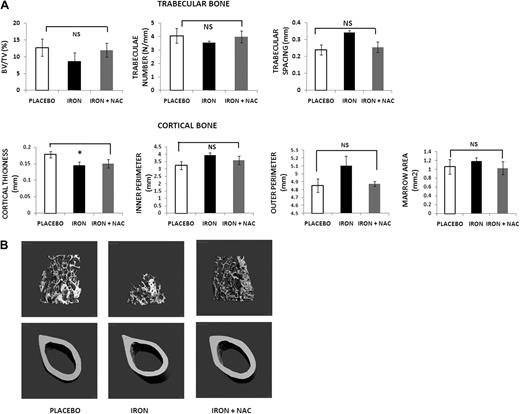Figure 4. Treatment with an antioxidant prevents the bone loss induced by iron overload. (A) Micro-CT analysis of mice treated with placebo, iron dextran alone, or iron dextran plus NAC for 2 months: placebo (▭), iron dextran (▬), and iron + NAC (). Data are mean ± SD. NS indicates not significant. *P < .01. (B) Micro-CT images of placebo, iron dextran, and iron dextran + NAC animals. Trabecular bone at distal femur and cortical bone at mid-diaphysis femur.