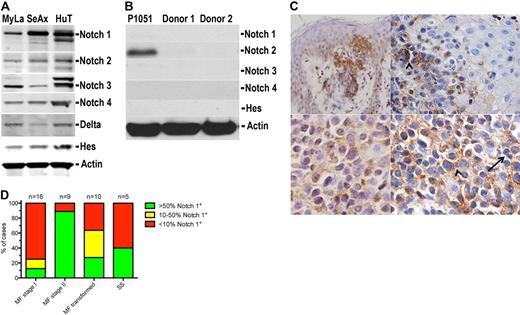 Figure 1. Expression of Notch family proteins in CTCL. (A) Western blot analysis of whole-cell lysates from CTCL cell lines: MyLa (lane 1), SeAx (lane 2), and Hut78 (lane 3). The blots were probed with the antibodies against Notch1 to Notch4; the intracellular domains are visualized as bands at approximately 110 kDa (Notch1 and Notch2), approximately 90 kDa (Notch3), and approximately 52 kDa (Notch4), Notch ligand, Delta, and Hes, the transcriptional factor induced by Notch signaling. (B) Western blot analysis of normal proliferating T cells (P1051) and nonproliferating leukocytes from 2 healthy donors probed for Notch1 to Notch4 and Hes1. (C) Immunostaining for Notch1 in skin biopsies from a patient with tumor-stage MF (top images, UplanSApo 40×/0.90; bottom images, UplanSApo 60×/0.90 using Olympus BX51 microscope with camera Olympus DP70) showing high Notch1 expression in tumor cells. The staining was mainly cytoplasmic and membranous. Arrowhead (top right image) indicates epidermiotropic Notch1-positive tumor cells as displayed in bottom right image at higher magnification. The arrow indicates Notch1-negative small reactive T lymphocytes. (D) Quantification of Notch1 expression in biopsies from lesional skin from patients with MF in stage I (patch and plaque), stage II (tumors), transformed MF, and SS. The histograms represent the percentage of patients classified into one of the 3 categories (negative, moderately positive, and positive), as described in “Immunohistochemistry.” Comparison of the expression profiles shows statistical significant increase in Notch expression with stage (P = .017).