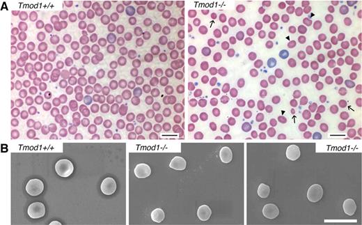 Figure 5. Tmod1-null RBC shapes are heterogeneous with rounded elliptocytes, spherocytes, and microcytes, resembling spherocytic elliptocytosis. (A) Peripheral blood smears from Tmod1−/−Tg+ mice show significant populations of rounded elliptocytes (arrowheads), as well as spherocytes and a few microcytes (arrows). (B) Scanning electron microscopy (SEM) of RBCs from a Tmod1+/+Tg+ mouse and a Tmod1−/−Tg+ mouse show reduction of the central biconcavity as well as oval-shaped, spherical, and some smaller cells in the absence of Tmod1. Bars, 10 μm.