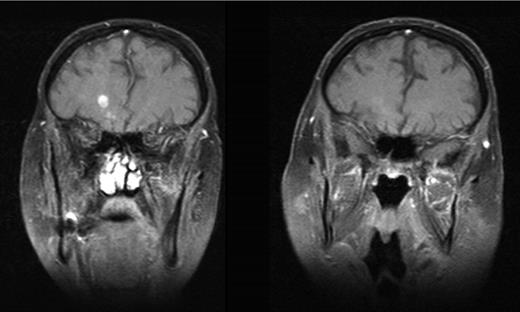 Figure 1. MRI scans before and during continuous dasatinib therapy. The left picture shows a representative MRI slice before dasatinib treatment. The right slide shows the same area approximately 9 months later. Pictures are representative of a total of 4 lesions with similar development.